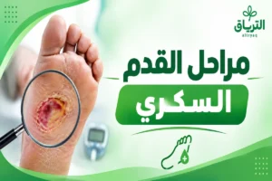 مراحل القدم السكري: الأعراض والعلامات ومتى يجب زيارة الطبيب